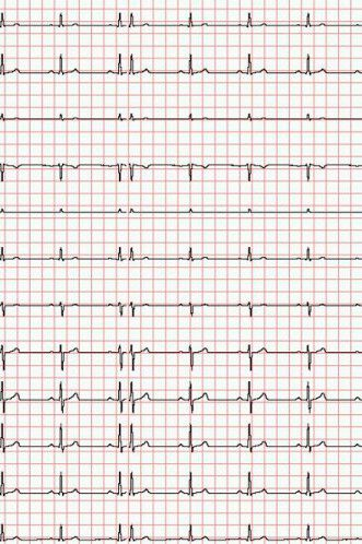 Registrierpapier für EKG Cardio-M-Plus - Medical Econet EKG - 1 Rolle