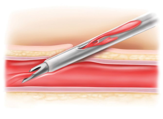 Becton Dickinson Insyte™ Autoguard™ Sicherheitsvenenverweilkatheter mit Flügeln 20G x 30 mm, rosa